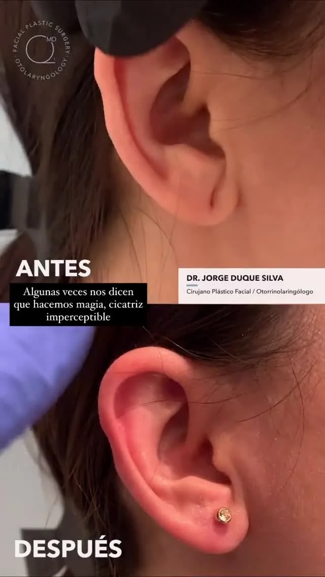 Reconstrucción de lóbulo rasgado antes y después - Dr. Jorge Duque Silva, Madrid